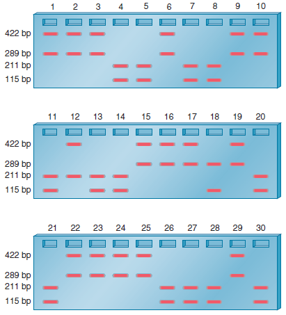 Take a look at solved problem S1. Let's suppose a male is heterozygous for two polymorphic sequence-tagged sites. STS-1 exists in two sizes: 211 bp and 289 bp. STS-2 also exists in two sizes: 115 bp and 422 bp. A sample of sperm was collected from this man, and individual sperm were placed into 30 separate tubes. Into each of the 30 tubes were added the primers that amplify STS-1 and STS-2, and then the samples were subjected to PCR. The following results were obtained: a. What is the arrangement of these STSs in this individual B. What is the linkage distance between STS-1 and STS-2 C. Could this approach of analyzing a population of sperm be applied to RFLPs