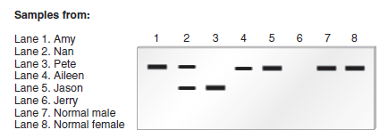 Chapter 20 describes a blotting method known as Western blotting that can be used to detect a polypeptide that is translated from a particular mRNA. In this method, a particular polypeptide or protein is detected by an antibody that specifically recognizes a segment of its amino acid sequence. After the antibody binds to the polypeptide within a gel, a secondary antibody (which is labeled) is used to visualize the polypeptide as a dark band. For example, an antibody that recognizes -galactosidase A could be used to specifically detect the amount of -galactosidase A protein on a gel. The enzyme -galactosidase A is defective in individuals with Fabry disease, which shows an X-linked recessive pattern of inheritance. Amy, Nan, and Pete are siblings, and Pete has Fabry disease. Aileen, Jason, and Jerry are brothers and sister, and Jerry has Fabry disease. Amy, Nan, and Pete are not related to Aileen, Jason, and Jerry. Amy, Nan, and Aileen are concerned that they could be carriers of a defective -galactosidase A gene. A sample of cells was obtained from each of these six individuals and subjected to Western blotting, using an antibody against -galactosidase A. Samples were also obtained from two unrelated normal individuals (lanes 7 and 8). The results are shown here.    a. Note: Due to X inactivation in females, the amount of expression of genes on the single X chromosome in males is equal to the amount of expression from genes on both X chromosomes in females a. Explain the type of mutation (i.e., missense, nonsense, promoter, etc.) that causes Fabry disease in Pete and Jerry b. What would you tell Amy, Nan, and Aileen regarding the likelihood that they are carriers of the mutant allele and the probability of having affected offspring