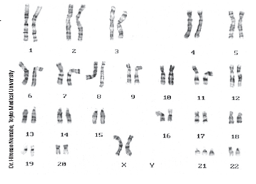 Given the karyotype shown at right, is this a male or a female? Normal or abnormal? What would the phenotype of this individual be?