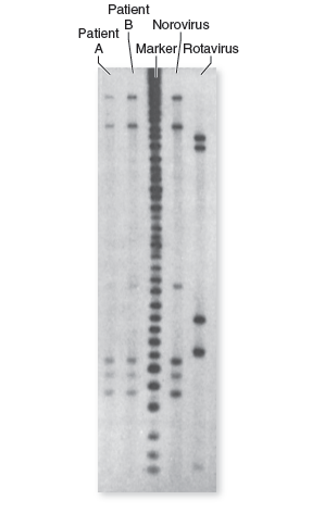 Critical thinking is the ability to reason and solve problems using facts and concepts. These questions can be approached from a number of angles and, in most cases, they do not have a single correct answer. a. Define the term RFLP. Explain how RFLPs are created and why they are useful in DNA analysis. b. In the following DNA profile, identify the pathogen that is making the two patients ill and explain your answer.   