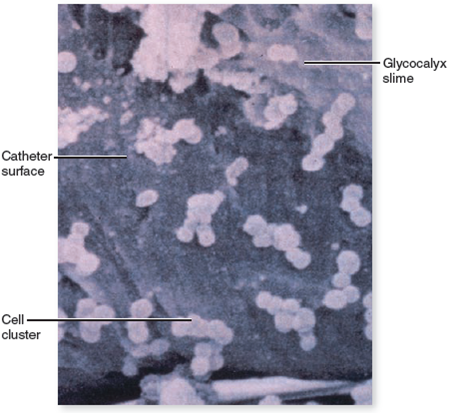 From chapter 4, figure 4.15. In what setting was this infection most likely acquired What is this type of infection called What could be the source of the pathogen Figure 4.15. Biofilm formation. Scanning electron micrograph of Staphylococcus aureus cells attached to a catheter by a slime secretion.