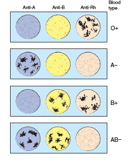 Figure 16.10 c. Draw the expected agglutination pattern for auniversal donor blood type. Figure 16.10 Interpretation of blood typing. In this test, a drop of blood is mixed with a specially prepared antiserum known to contain antibodies against the A, B, or Rh antigens. (c) Several patterns and their interpretations. Anti-A, anti-B, and anti-Rh are shorthand for the antisera applied to the drops. (In general, O+ is the most common blood type, and AB- is the rarest.)