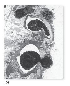 From chapter 14, figure 14.19. Imagine that the WBCs shown in this illustration are unable to control the microorganisms. Could the change that has occurred in the vessel wall help the organism spread to other locations If so, how Diapedesis (a) View of a venule depicts white blood cells squeezing themselves between spaces in the blood vessel wall via diapedesis. This process, shown in cross section, indicates how the pool of leukocytes adheres to the endothelial wall. From this site, they are poised to migrate out of the vessel into the tissue space. b. If the organisms are able to survive phagocytosis, how could that impact the progress of this disease Explain your answer chemotaxis of leukocytes. (b) This photograph captures neutrophils in the process of diapedesis.