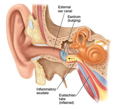 Figure 21.2. Some doctors suggest that gently forcing one's ears to pop is an effective way to prevent ear infection. Use the following illustration to explain how this could work. Figure 21.2. An infected middle ear.    