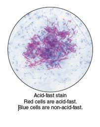 From chapter 3, figure 3.21. Although there are many different organisms present in the respiratory tract, an acidfast stain of sputum, like the one shown here, along with patient symptoms can establish a presumptive diagnosis of tuberculosis. Explain why. Figure 3.21 Microbiological stains. Acid-fast stain