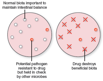 From chapter 12, figure 12.15. Assume that the growth on the first plate represents normal intestinal microbiota. How could you use these illustrations to explain the development of C. difficile -associated colitis   Figure 12.15: The role of antimicrobials in disrupting microbial biota and causing superinfections. (a) A primary infection in the throat is treated with an oral antibiotic. (b) The drug is carried to the intestine and is absorbed into the circulation. (c) The primary infection is cured, but drug-resistant pathogens have survived and create an intestinal superinfection.  <div style=padding-top: 35px> 