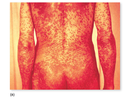 From chapters 20 and 23, figures 20.16 and 23.13 a. Compare these two rashes. What kind of information wouldhelp you determine the diagnosis in both cases b. Now compare both of these to the rashes summarized in Disease Table 18.7 (p. 532-533). Which of the diseases in Disease Table 18.7 most resembles the rashes in the preceding question, and how would you distinguish among it, the rash from figure 20.16, and the one from figure 23.13 a Figure 20.16: The rash in RMSF. This case occurred in a child several days after the onset of fever. Also pictured is an example of the hard ticks that transmit the infection.   Figure 23.13 a : Symptom of secondary syphilis. The skin rash in secondary syphilis can form on the trunk, arms, and even palms and soles (these latter locations are particularly diagnostic). The rash does not hurt or itch and can persist for months.   Disease Table 18.7: Maculopapular Rash Diseases  <div style=padding-top: 35px> 
