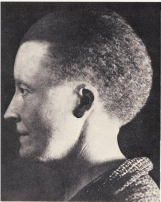 Why Woolly Hair Runs in Families  The woman in the photo on the right does not cut her hair. Her hair breaks off naturally as it grows, keeping it from getting long. Other members of her family have the same sort of hair, suggesting it is a hereditary trait. Because of its curly, fuzzy texture, this trait has been given the name woolly hair. While the woolly hair trait is rare, it fl ares up in certain families. The extensive pedigree below (drawn curved so as to fi t in the large families produced by the second and subsequent generations) records the incidence of woolly hair in fi ve generations (the Roman numerals on the left) of a Norwegian family. As is the convention, affected individuals are indicated by solid symbols, with circles females and squares males. The pedigree below will provide you with the information you need to discover how this trait is inherited within human families.     Making Inferences  a. Is woolly hair sex-linked or autosomal  b. Is woolly hair dominant or recessive  c. Is the woolly hair trait determined by a single gene, or by several