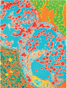 Why Do STDs Vary in Frequency As a general rule, the incidence of a sexually transmitted disease is expected to increase with increasing frequencies of unprotected sexual contact. With the emergence of AIDS, intense publicity and education has lessened such dangerous behavior. Both the number of sexual partners and the frequency of unprotected sex have fallen significantly in the United States in the last decade. It would follow, then, that the frequencies of sexually transmitted diseases (STDs) like syphilis, gonorrhea, and chlamydia should also be falling. However, the level of one STD sometimes rises while another falls. What are we to make of this The simplest explanation of such a difference is that the two STDs are occurring in different populations, and one population has rising levels of sexual activity, while the other has falling levels. However, nationwide statistics encompass all population subgroups, and there is no reason to expect subgroups to contain different STDs. Certainly each major subgroup contains all three major STDs mentioned above. So this would seem an unlikely explanation for the frequency of one STD to be rising while another falls. A second possible explanation would be a change in the infectivity of one of the STDs. A less infective STD would tend to fall in frequency in the population, for the simple reason that fewer sexual contacts result in infection. To assess this possibility, we must examine the individual STDs more closely. Syphilis is most infective in its initial stage, but this stage lasts only about a month. Most transmissions occur during the much longer second stage, marked by a pink rash and sores in the mouth. The bacteria can be transmitted at this stage by kissing or shared liquids. Any drop in infectivity of this STD would be expected to shorten this stage-but no such shortening has been observed. Gonorrhea can be transmitted by various forms of sexual contact with an infected individual at any time during the infection. There has been no drop in infectivity per sexual contact reported. Chlamydia offers the most interesting possibility of changes in infectivity, because of its unusual nature. Chlamydia trachomatis is genetically a bacterium but is an obligate intracellular parasite, much like a virus in this respect-it can reproduce only inside human cells. The red structures in the photo are chlamydia bacteria inside human cells. Like gonorrhea, chlamydia is transmitted through vaginal, anal, or oral intercourse with an infected person. With chlamydia, the person may show no symptoms. Because the disease agent lives inside cells, its infectivity would not be expected to change unless the number of cells of an infected individual to which his or her sex partner would be exposed during intercourse were to change, a very unlikely possibility. So a drop in infectivity doesn't seem very likely. There is, however, a third possible explanation for why the frequency of one STD in a population might rise while the frequency of another STD in that same population falls. To grasp this third possible explanation, we will need to examine carefully the trends in the incidence in the United States of the gonorrhea, chlamydia, and syphilis. Detailed yearly statistics are reported in the graph above.     Drawing Conclusions How might heightened public awareness explain why the trend in levels of gonorrhea differs from that of chlamydia<div style=padding-top: 35px> 