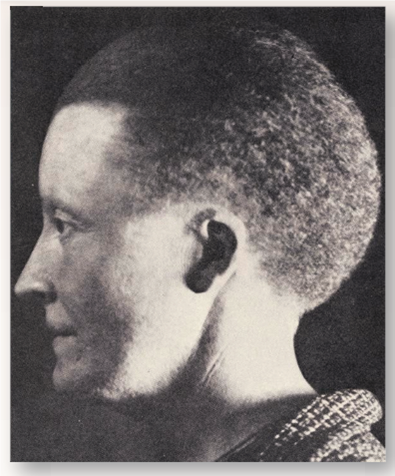 Why Woolly Hair Runs in Families  The woman in the photo on the right does not cut her hair. Her hair breaks off naturally as it grows, keeping it from getting long. Other members of her family have the same sort of hair, suggesting it is a hereditary trait. Because of its curly, fuzzy texture, this trait has been given the name woolly hair. While the woolly-hair trait is rare, it flares up in certain families. The extensive pedigree below (drawn curved to fit the large families produced by the second and subsequent generations) records the incidence of woolly hair in five generations (the roman numerals on the left) of a Norwegian family. As is the convention, affected individuals are indicated by solid symbols, with circles females and squares males. The pedigree below will provide you with the information you need to discover how this trait is inherited within human families.      Applying Concepts In the diagram below, how many individuals are documented? Are all of them related?