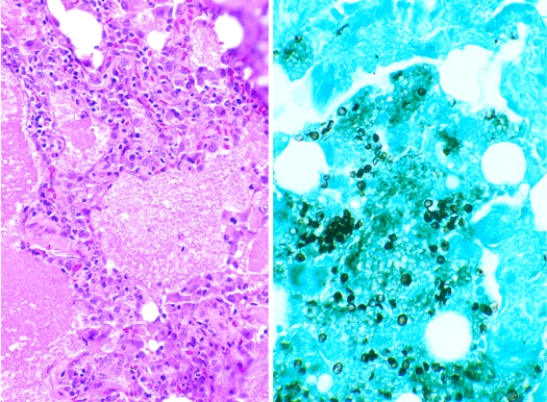 This lung lesion was identified at the autopsy of a 40-year-old man infected with human immunodeficiency virus (HIV) . It is illustrated here in a hematoxylin and eosin stained section and a silver methenamine impregnated section. This lesion is caused by a   A)  bacterium B)  fungus C)  virus D)  protozoon E)  nematode