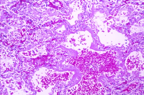 This lung lesion was found at the autopsy of a 40-year-old man who suffered extensive burns to 50% of his body surface. These changes are most consistent with the diagnosis of   A)  atelectasis B)  emphysema C)  bronchiolitis obliterans-organizing pneumonia (BOOP)  D)  adult respiratory distress syndrome E)  lobar pneumonia