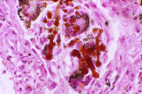 This lung lesion is diagnostic of   A)  anthracosis B)  asbestosis C)  silicosis D)  bagassosis E)  berylliosis