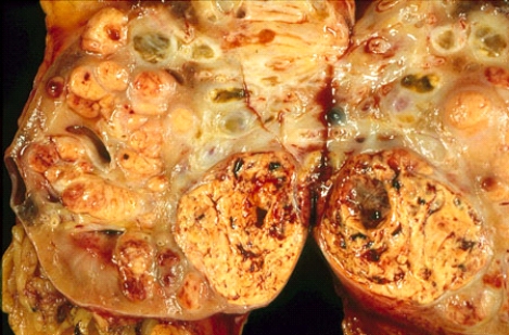 This nephrectomy specimen shows a lesion in the kidney of a 63-year-old man. The lesion is most likely related to   A)  a deletion of von Hippel-Lindau (VHL)  tumor suppressor gene B)  a mutation of myc oncogene C)  an amplification of ras oncogene D)  a loss of bcl-2 proapoptotic gene E)  an aflatoxin related carcinogen