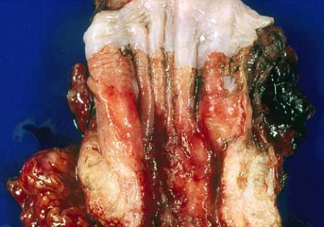 This esophageal carcinoma developed in a 65-year-old man who had reflux esophagitis for 15 years. Most likely this tumor was histologically classified as   A)  adenocarcinoma B)  squamous cell carcinoma C)  transitional cell carcinoma D)  basal cell carcinoma E)  oat cell carcinoma