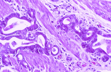 This slide shows the muscle layer of a stomach that was removed from a 60-year-old man who complained of dyspepsia and bleeding. The tissue section was taken from the muscle underneath a large prepyloric ulcer. Which of the following is the most likely diagnosis?   A)  Peptic ulcer disease B)  Helicobacter pylori-related gastritis C)  Autoimmune gastritis D)  Hyperplastic gastropathy E)  Adenocarcinoma
