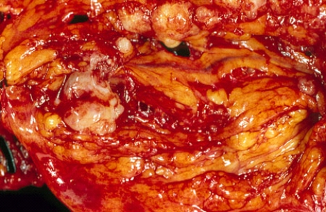This figure shows a portion of the mesentery and omentum removed during a work-up of a 60-year-old woman with ascites and large multicystic ovarian masses. The lesions seen here are most consistent with the diagnosis of   A)  primary peritoneal benign tumor B)  primary peritoneal malignant tumor C)  metastatic carcinoma D)  metastatic sarcoma E)  lymphoma