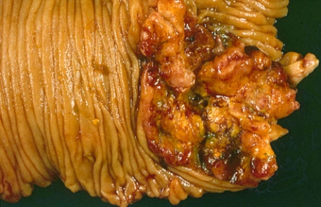 This small intestinal lesion was removed from a 56-year-old woman and is most likely a   A)  tubular adenoma B)  hamartoma C)  carcinoma D)  sarcoma E)  pseudopolyp