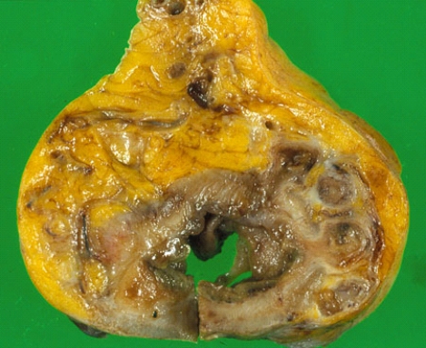 This slide illustrates the lesions seen in the partial colectomy specimen obtained from a 78-year-old man who has chronic constipation, left lower quadrant pain, and fever. On cross section, this sigmoid colon shows changes most consistent with the diagnosis of   A)  Crohn disease B)  toxic megacolon C)  carcinoma of the colon D)  carcinoid E)  diverticulitis