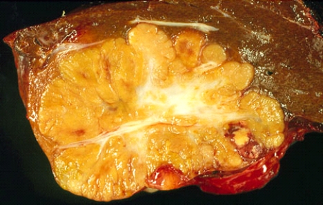 This liver tumor nodule, measuring 6 cm in diameter, was seen on a computerized tomography (CT)  scan of a 40-year-old man. Initially, the nodule was considered to be benign, but when it became painful, the patient decided to have it removed. Histologically, it was composed of well-differentiated hepatocytes, whereas the central scar and the fibrous septa contained proliferating bile ducts. This nodule is most likely   A)  a hepatocellular adenoma B)  a hamartoma C)  an adenomyoma D)  a focal nodular hyperplasia E)  a hepatocellular carcinoma