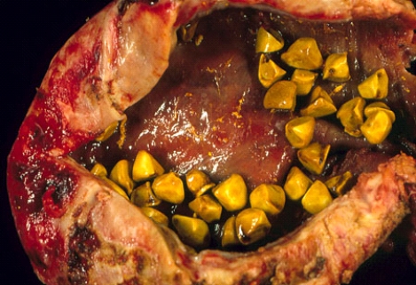These gallstones surgically removed along with the gallbladder of a 50-year-old obese woman are composed predominantly of   A)  calcium carbonate B)  cholesterol C)  bilirubin D)  biliverdin E)  calcium hydroxyapatite
