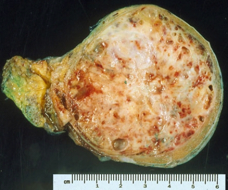 This testis was removed from a 30-year-old man. It most likely represents   A)  an adenocarcinoma B)  a squamous cell carcinoma C)  a seminoma D)  a nonseminomatous germ cell tumor E)  a Leydig cell tumor