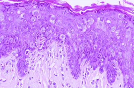 This biopsy specimen was taken from an excoriated and oozing nipple of a 50-year-old woman. These histologic findings are most consistent with the diagnosis of   A)  eczema B)  psoriasis C)  Paget disease of the breast D)  medullary carcinoma of the breast E)  fibrocystic change of the breast