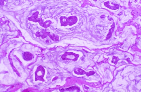 This breast tumor was removed from a 60-year-old woman. On gross examination, the tumor was found to be   A)  rubbery and yellow B)  white and gritty C)  calcified D)  necrotic and caseous E)  soft and gelatinous