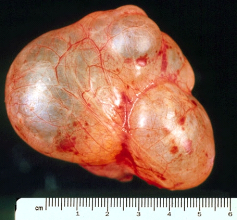 This pelvic tumor most likely originated from the   A)  prostate B)  rectum C)  urinary bladder D)  ovary E)  uterus