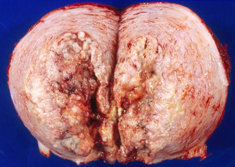 This uterus was removed from a 58-year-old woman who complained of metrorrhagia. Most likely this lesion is pathogenetically related to   A)  herpesvirus infection B)  human papillomavirus infection C)  hyperestrinism D)  multiparity E)  endometriosis