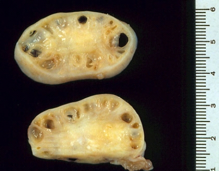 These ovaries were removed from an infertile, obese, slightly hirsute 30-year-old woman with persistent menstrual irregularities. The cystic spaces seen in the ovaries represent   A)  foci of endometriosis B)  foci of endosalpingiosis C)  corpora lutea D)  corpora albicantia E)  dilated follicles filled with fluid