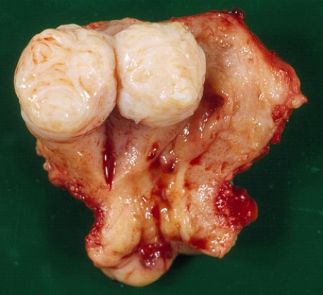 The solitary nodular lesion in this uterus removed from a 55-year-old woman is most likely composed of   A)  benign endometrial glandular cells B)  malignant endometrial glandular cells C)  benign smooth muscle cells D)  malignant smooth muscle cells E)  foci of adenomyosis