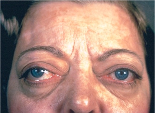 Thyroid ophthalmopathy is typically found in patients who have which of the following disorders?   A)  Graves disease B)  Multinodular goiter C)  Toxic (hyperfunctioning)  adenoma of the thyroid D)  Hashimoto thyroiditis E)  Riedel thyroiditis