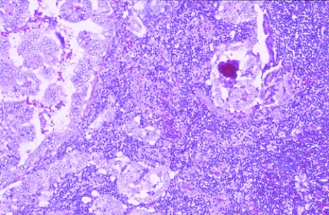This lymph node was removed from the lateral side of the neck of a 38-year-old woman who had a thyroidectomy. She had an enlarged, painless thyroid but had no signs of altered thyroid function. The lymph node shows signs of   A)  autoimmune disease B)  bacterial infection C)  hyperplasia D)  neoplasia E)  metaplasia