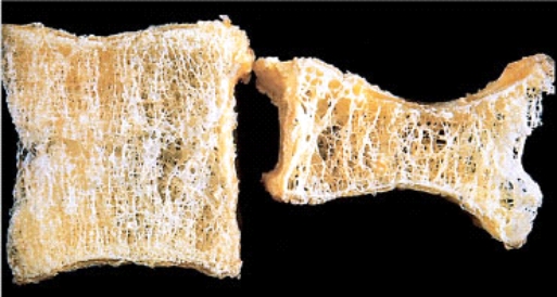 Compression fractures of vertebral bodies seen in elderly women are causally related to reduced recruitment of osteoclasts. This process is associated with an increased concentration of which chemical mediators in the bone?   A)  Prostaglandins B)  Leukotrienes C)  Cytokines such as interleukin (IL) -1 and IL-6 D)  Oncogenes such as c-MYC and K-RAS E)  Fibroblast growth factors