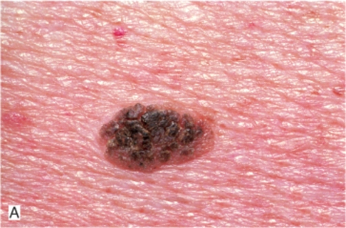 A well-demarcated, coin-like, dark brown lesion appeared on the shoulder of a 59-year-old man. The lesion appears velvety, greasy, and has a  stuck on  appearance so that it can easily be removed. Which of the following is the most likely diagnosis?   A)  Lentigo B)  Ephelis C)  Vitiligo D)  Seborrheic keratosis E)  Actinic keratosis