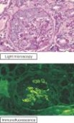 The figure shows routine histologic and immunofluorescence images of a kidney biopsy specimen taken from a 53-year-old man with acute-onset renal failure and hemoptysis (coughing up blood) . The histologic section is notable for glomerular inflammation in a crescentic distribution. Staining, using fluorescently tagged anti-IgG antibody, shows linear deposits of IgG along the glomerular basement membrane. Urinalysis is positive for moderate proteinuria and red cell casts. A chest radiograph shows pulmonary infiltrates. Which of the following is the most likely diagnosis?   A)  Systemic lupus erythematosus B)  Graves' disease C)  Chronic allograft rejection D)  Goodpasture's syndrome E)  Poststreptococcal glomerulonephritis