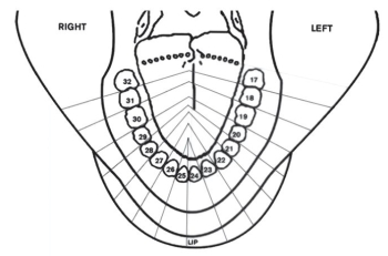 Color in the field of anesthesia and list the structures anesthetized by an inferior alveolar nerve block.   