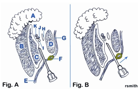 Using the figure below, identify the structures related to the needle pathway for the IA nerve block.   