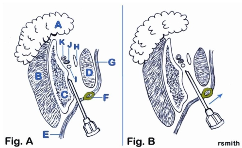 Using the figure below, describe the penetration site and needle pathway for an IA nerve block in relation to the surrounding anatomical structures.   
