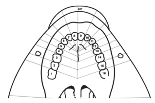 Color in the field of anesthesia and list the structures anesthetized by a nasopalatine nerve block.  <div style=padding-top: 35px> 