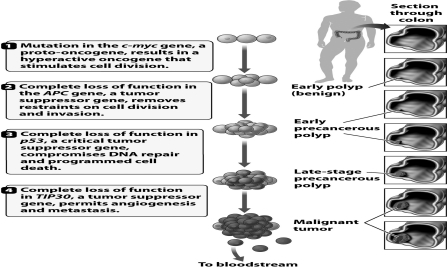 As indicated in the diagram below, in many human colon tumors, the beginning of true malignancy is the result of   A) the loss of the TIP30 tumor suppressor gene. B) the loss of the p53 tumor suppressor gene. C) the loss of the APC tumor suppressor gene. D) a mutation in the c-myc gene.