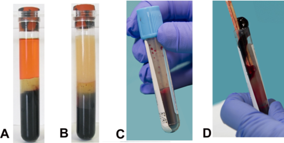   Which image represents a specimen that will be rejected by the laboratory? (check all that apply)  A)  Image A B)  Image B C)  Image C D)  Image D E)  All of the above 