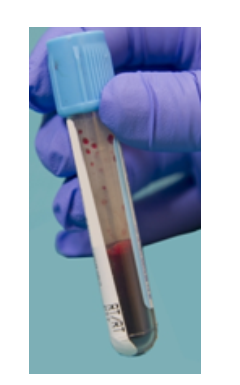    The specimen in this image needs to be recollected because A)  it has an incorrect additive to blood ratio. B)  RBCs have been destroyed, releasing calcium and potassium. C)  coagulation proteins have been activated. D)  the patient may not have been fasting. 