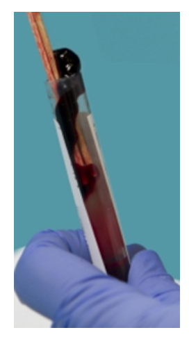    The specimen in this image needs to be recollected because A)  it has an incorrect additive to blood ratio. B)  RBCs have been destroyed, releasing calcium and potassium. C)  coagulation proteins have been activated. D)  the patient may not have been fasting. 