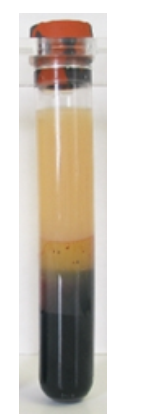   The specimen in this image needs to be recollected because A)  it has an incorrect additive to blood ratio. B)  RBCs have been destroyed, releasing calcium and potassium. C)  coagulation proteins have been activated. D)  the patient may not have been fasting. 