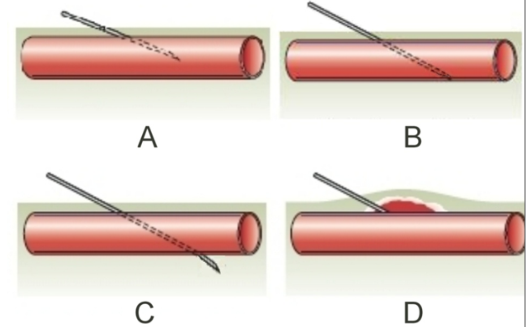   -Which of the images provided shows proper placement of the needle during venipuncture? A)  Image A B)  Image B C)  Image C D)  Image D 