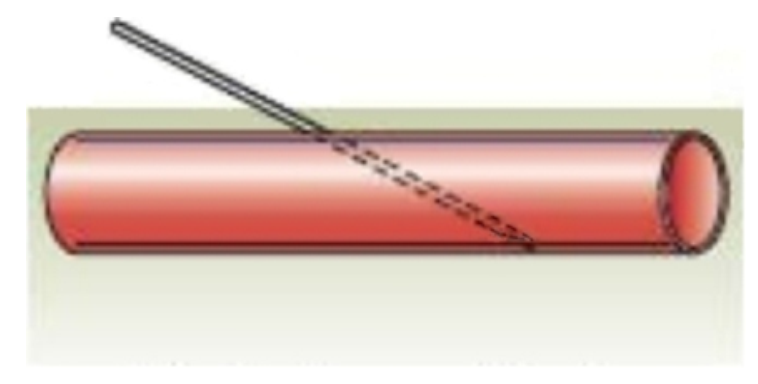 <strong>  What venipuncture situation is represented by this image?</strong> A) needle against vein wall B) needle inserted too deep C) needle inserted too shallow D) proper needle insertion <div style=padding-top: 35px> 