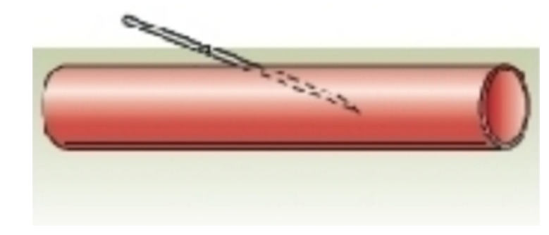 <strong>  What venipuncture situation is represented by this image?</strong> A) needle against vein wall B) needle inserted too deep C) needle inserted too shallow D) proper needle insertion <div style=padding-top: 35px> 