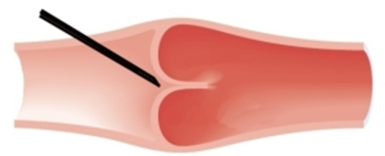 <strong>  What venipuncture situation is represented by this image?</strong> A) needle inserted against the vein wall B) needle inserted too close to a valve C) needle inserted too shallow D) proper needle insertion <div style=padding-top: 35px> 